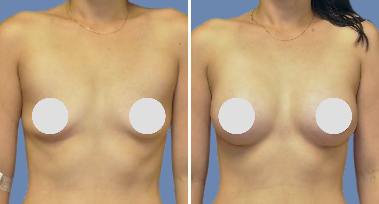 Breast Augmentation Before & After Gallery - Patient 241752 - Image 1