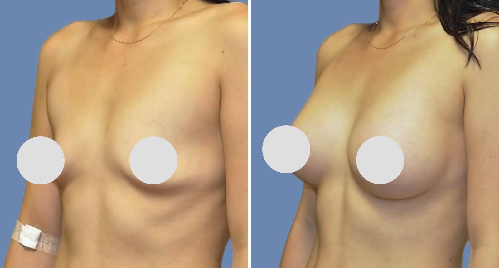 Breast Augmentation Before & After Gallery - Patient 241752 - Image 2