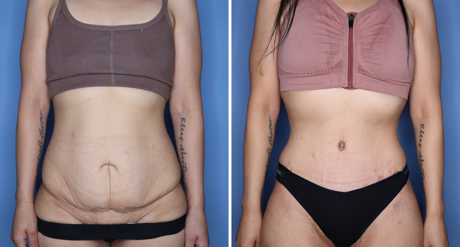 Abdominoplasty Before & After Gallery - Patient 260272 - Image 1