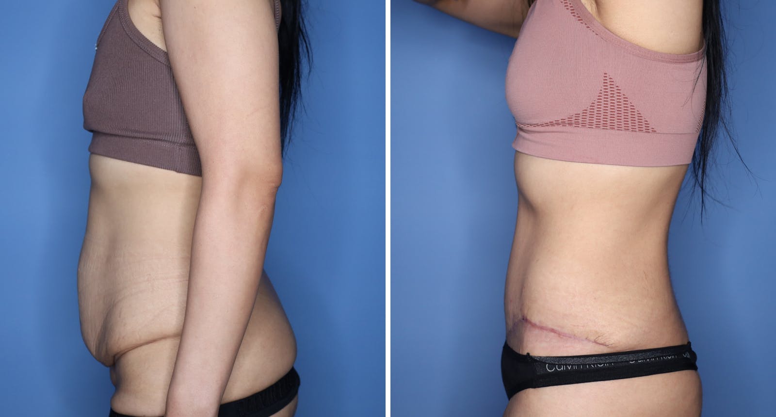 Abdominoplasty Before & After Gallery - Patient 260272 - Image 2