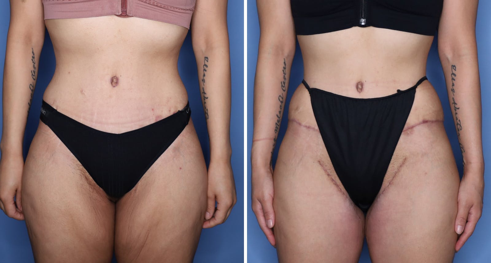 Abdominoplasty Before & After Gallery - Patient 260272 - Image 3