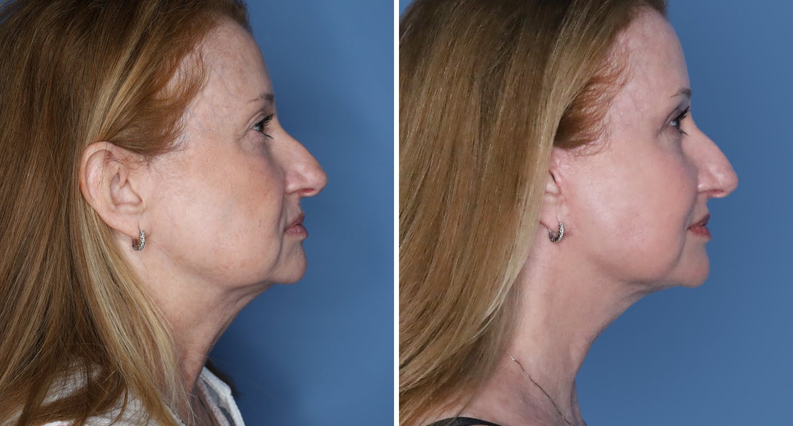 Facelift Before & After Gallery - Patient 125300 - Image 2
