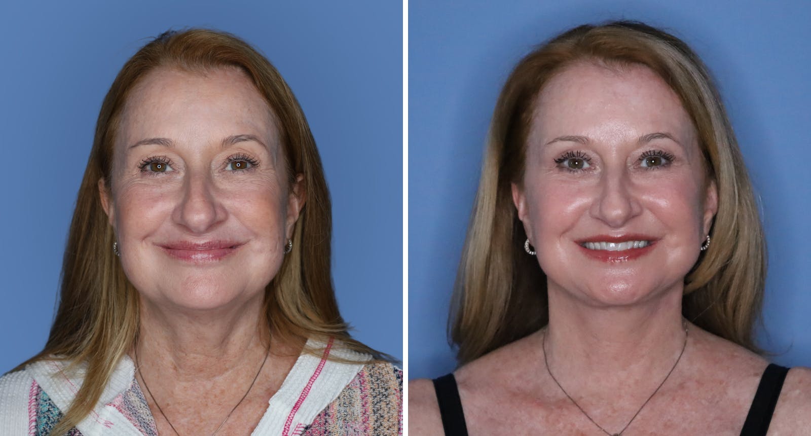 Facelift Before & After Gallery - Patient 125300 - Image 1
