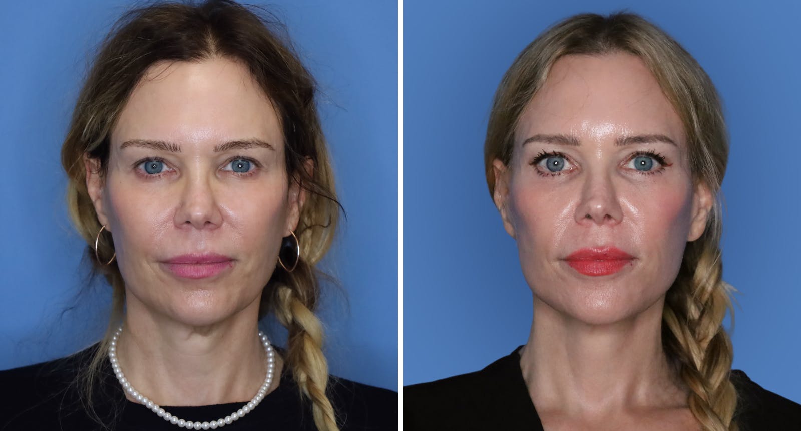 Facelift Before & After Gallery - Patient 139570 - Image 1