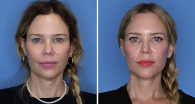 Facelift Before & After Gallery - Patient 139570 - Image 1