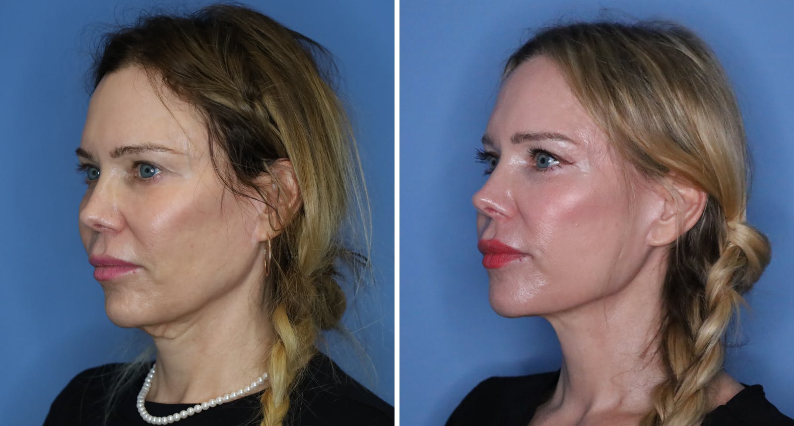 Facelift Before & After Gallery - Patient 139570 - Image 2