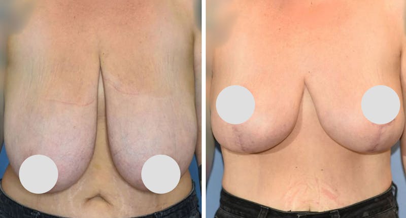 Patient XA2UbdbBT9SqDE95rEcMLA - Breast Reduction Before & After Photos