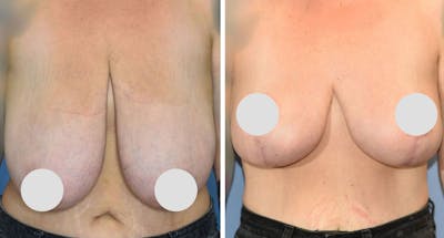 Breast Reduction Before & After Gallery - Patient 672806 - Image 1