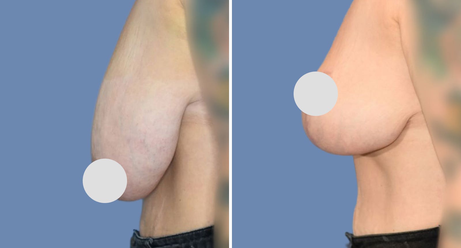 Breast Reduction Before & After Gallery - Patient 672806 - Image 2