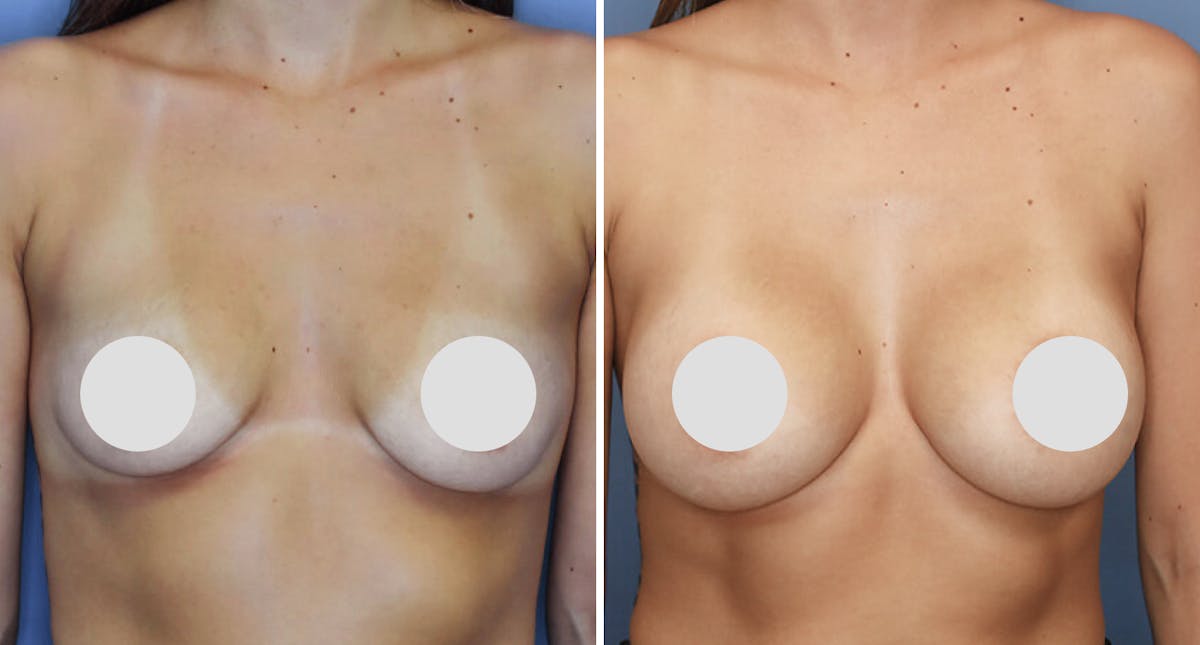 Breast Augmentation Before & After Gallery - Patient 718824 - Image 1