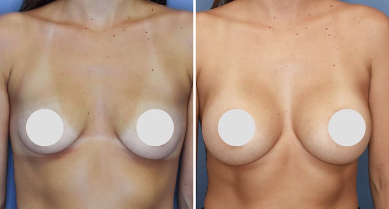 Patient XnNluuF2QuW3Eepd89QyVQ - Breast Augmentation Before & After Photos