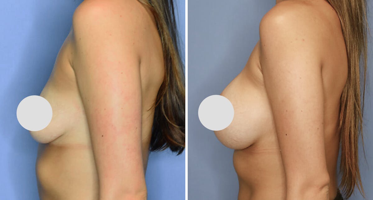 Breast Augmentation Before & After Gallery - Patient 718824 - Image 2