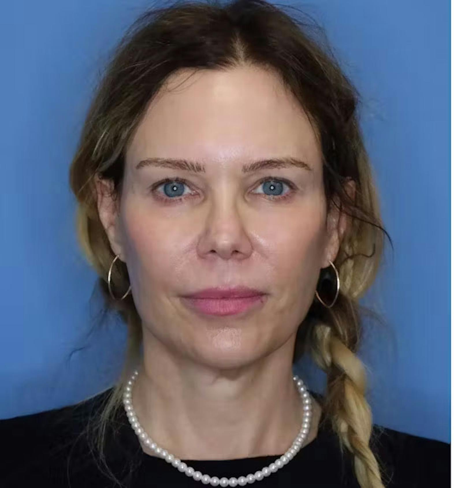 Facelift patient before media