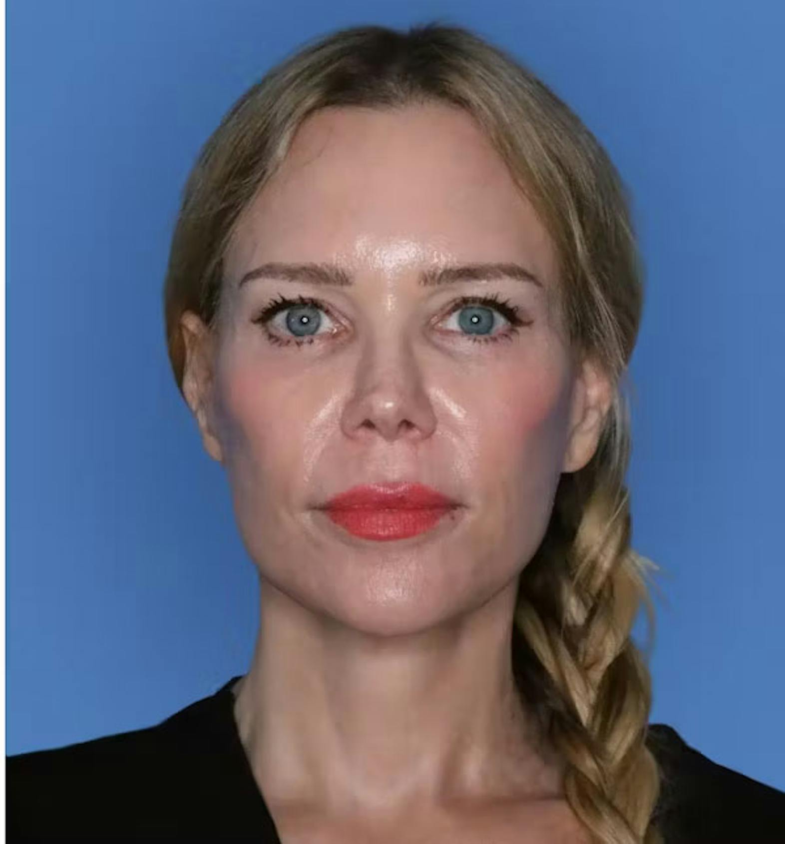 Facelift patient after media