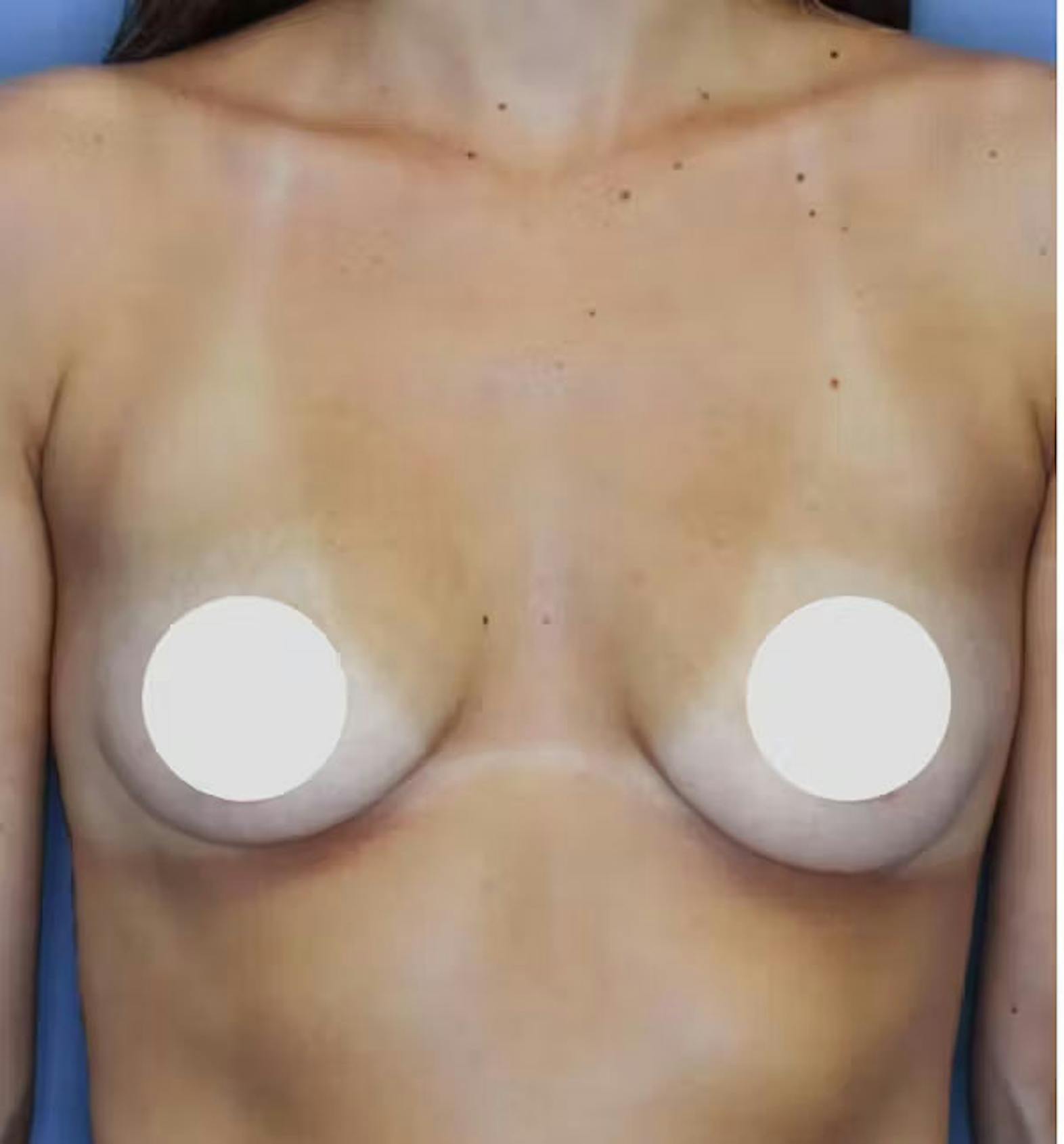 Breast augmentation patient before media