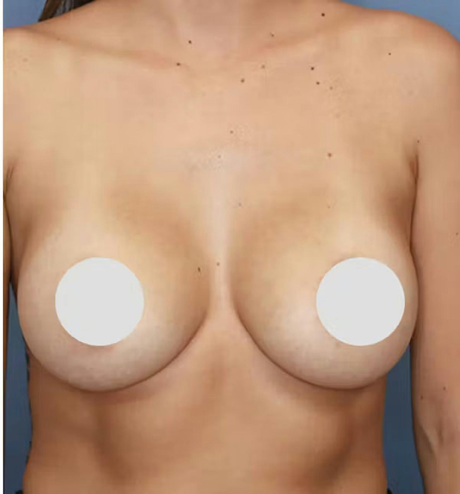 Breast augmentation patient after media