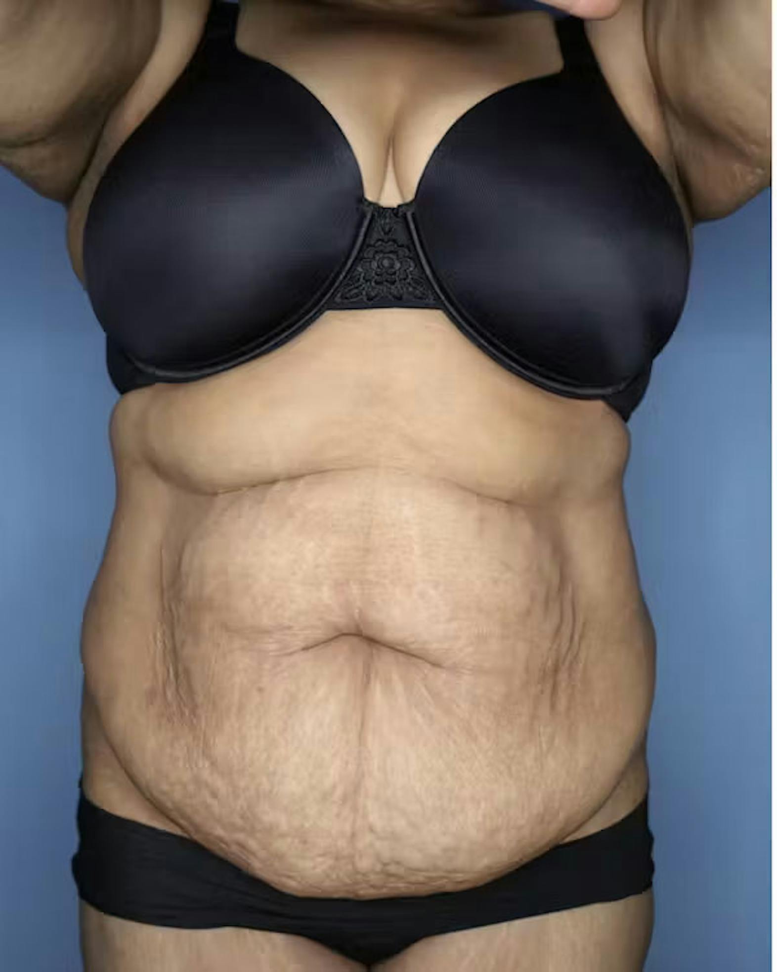 Abdominoplasty patient before media