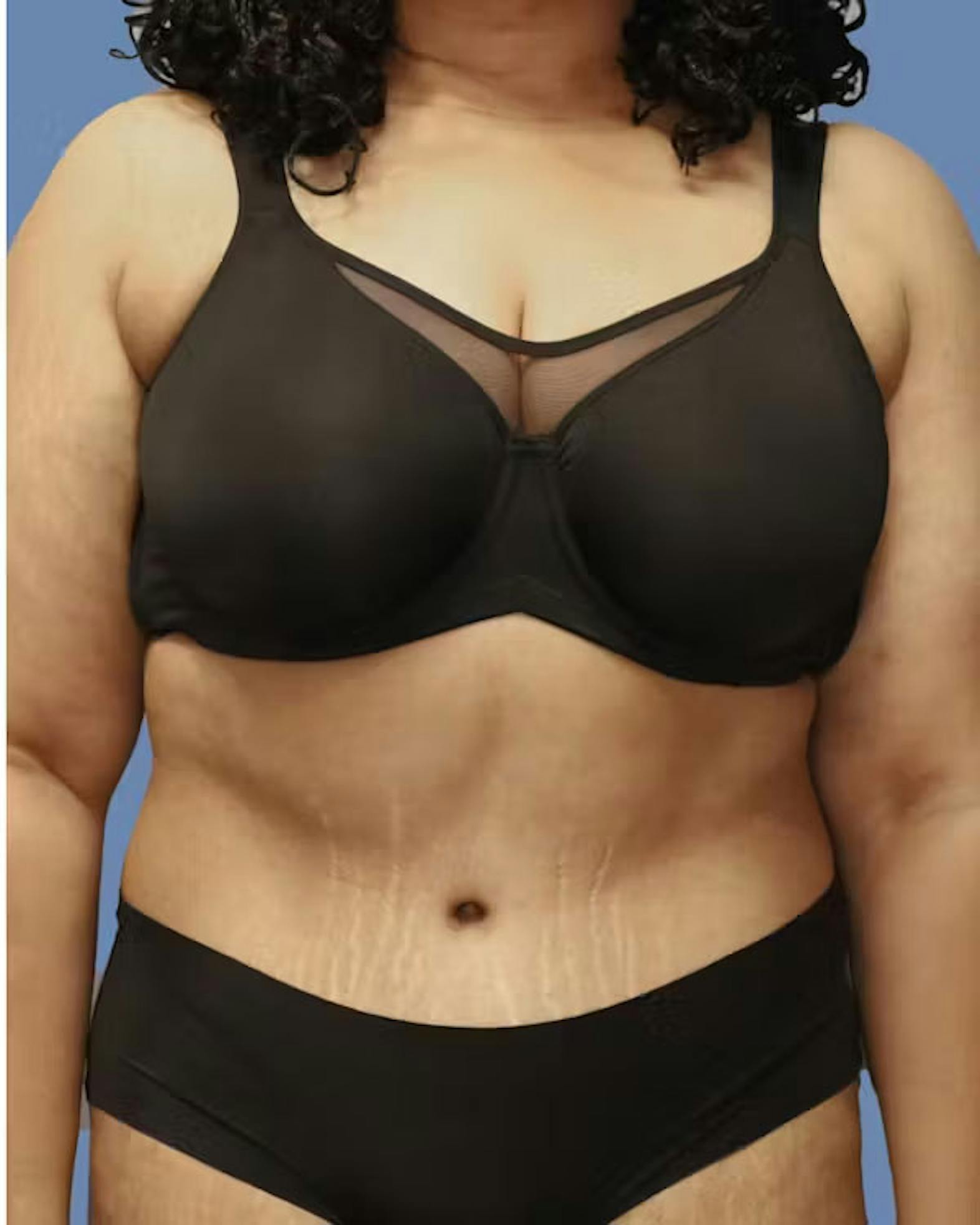 Abdominoplasty patient after media