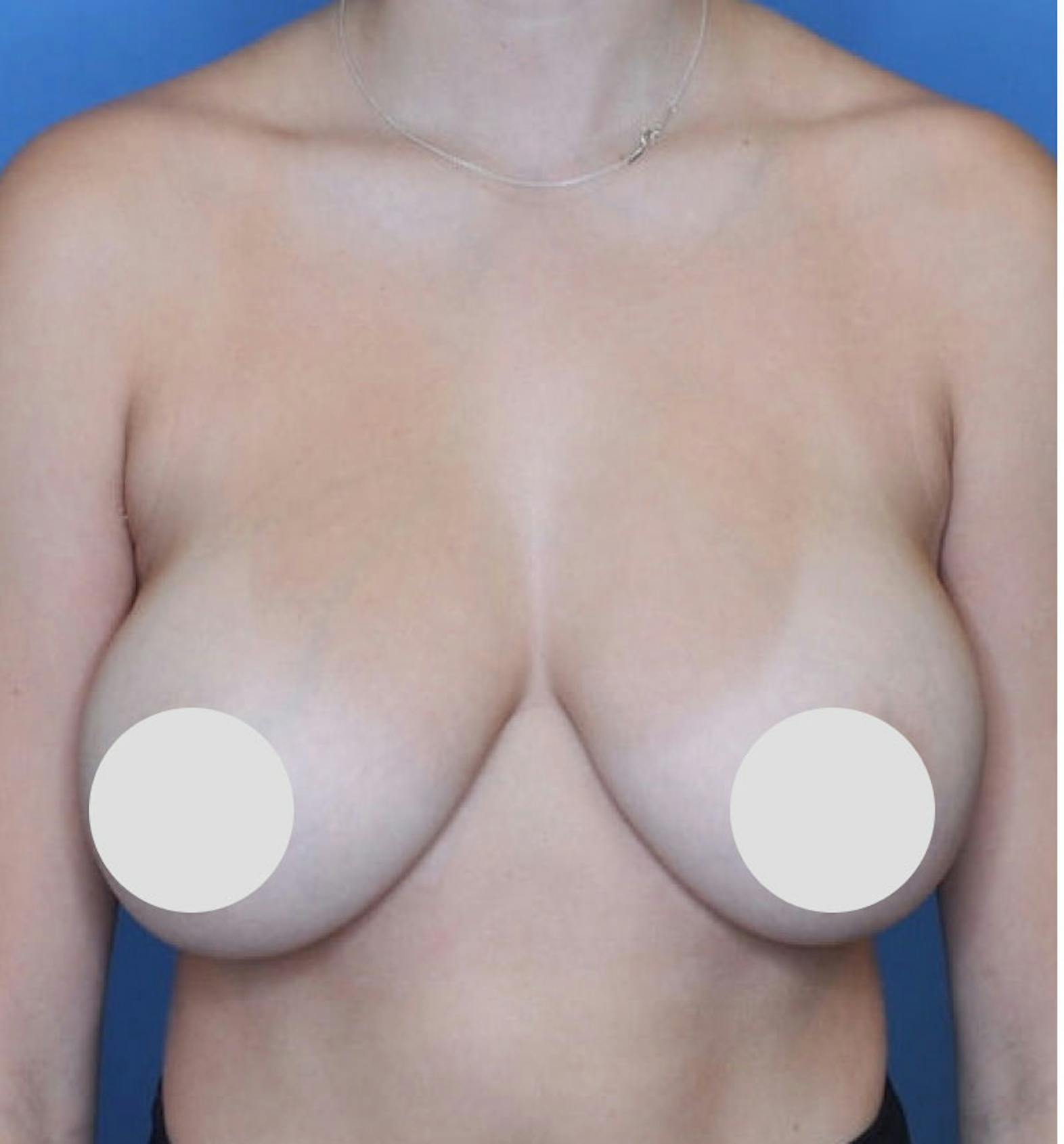 Breast reduction patient before media