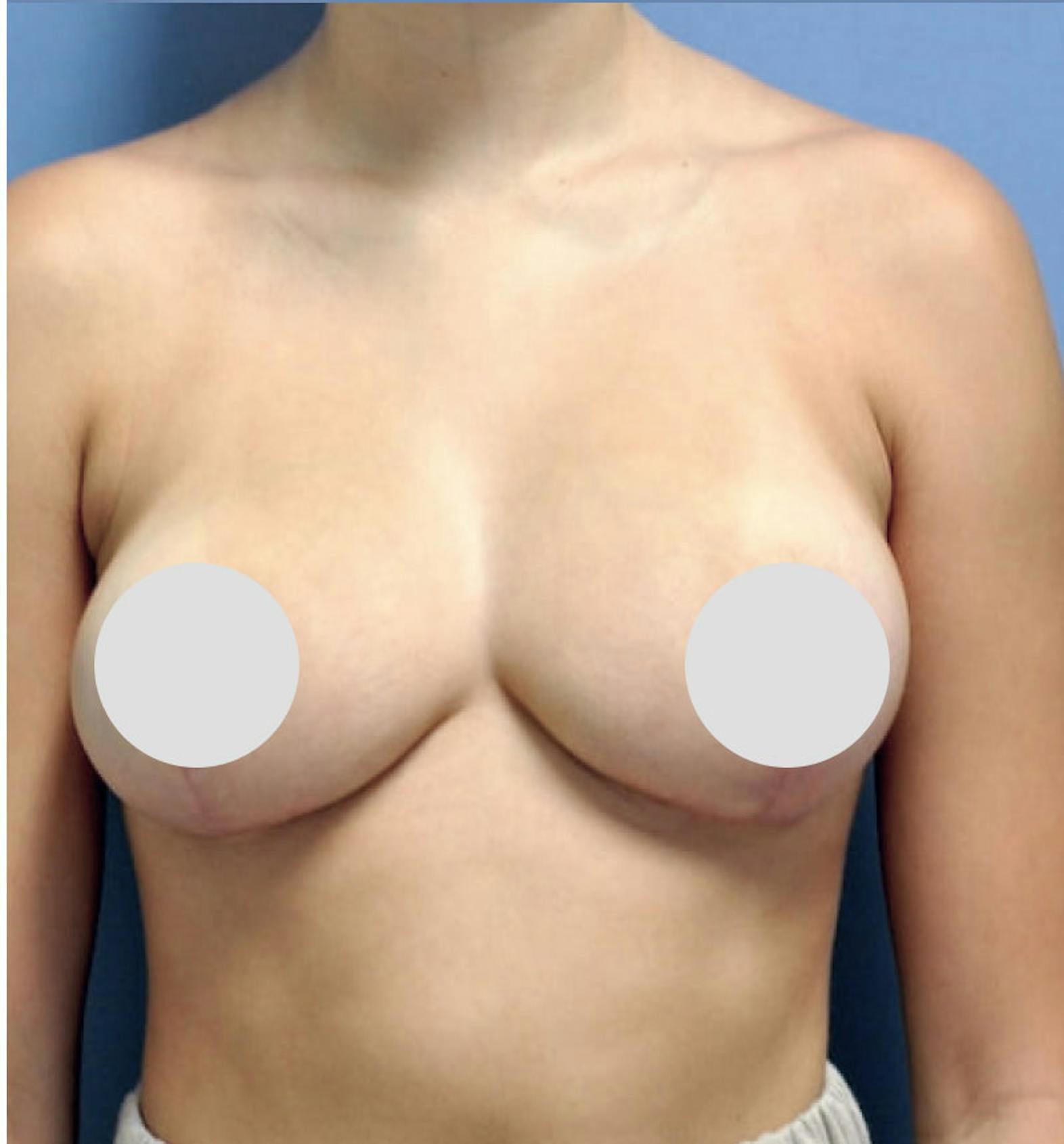 Breast reduction patient after media