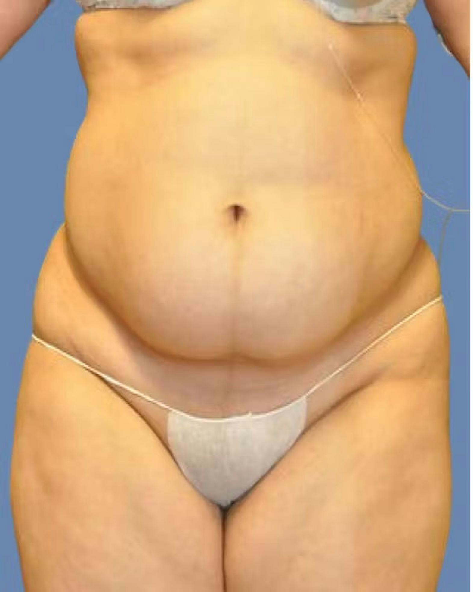 Liposuction patient before media