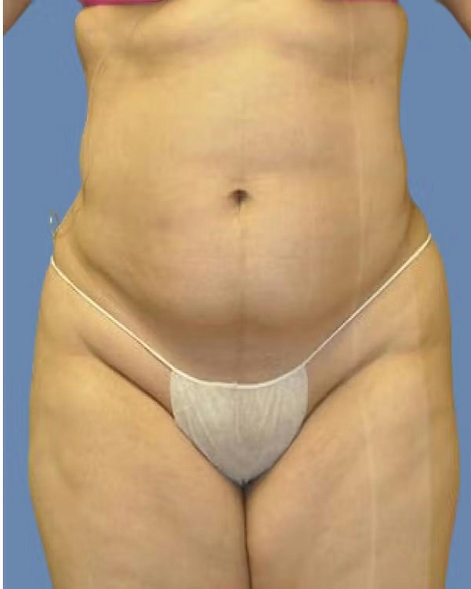 Liposuction patient after media