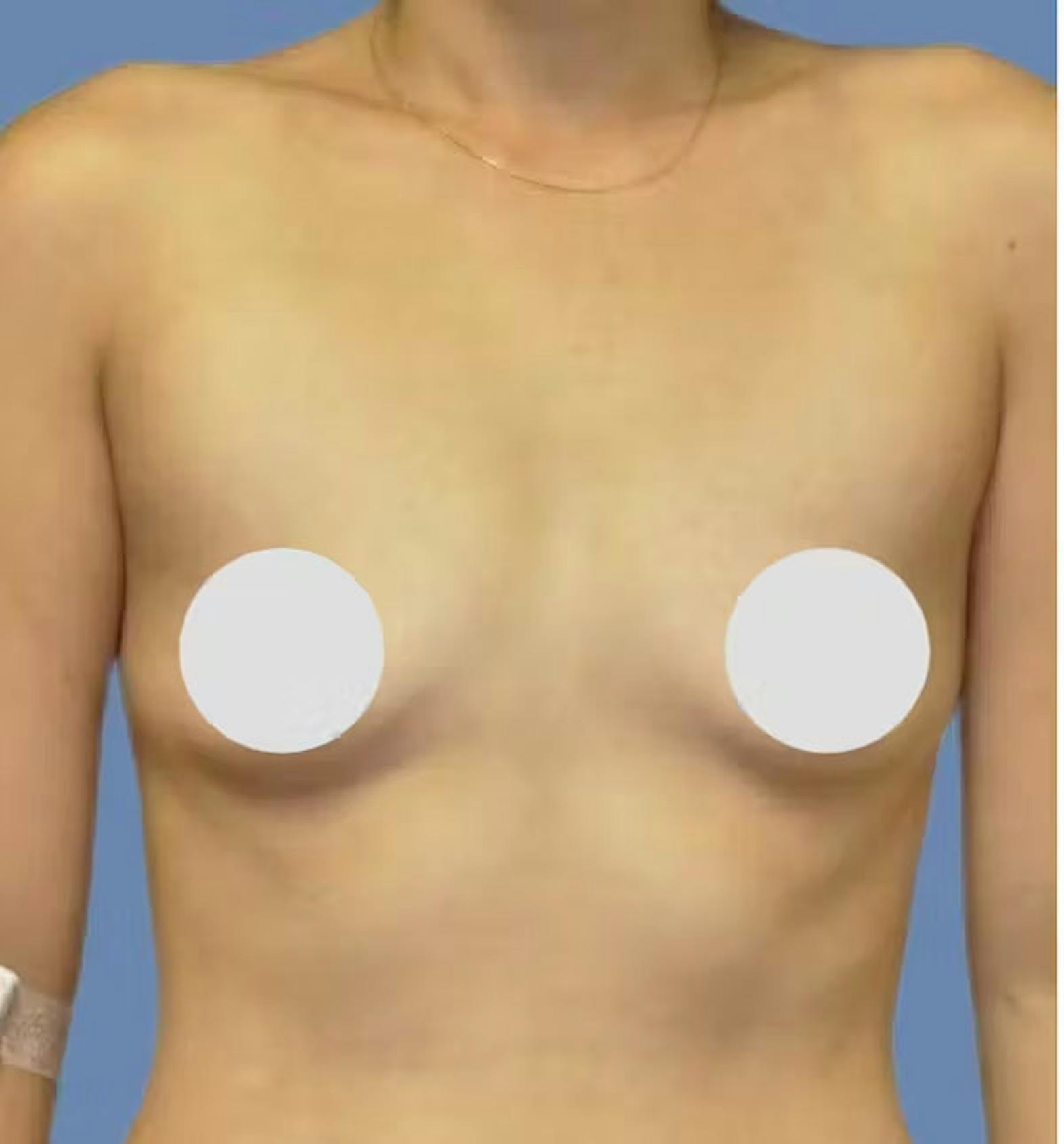Breast augmentation patient before media