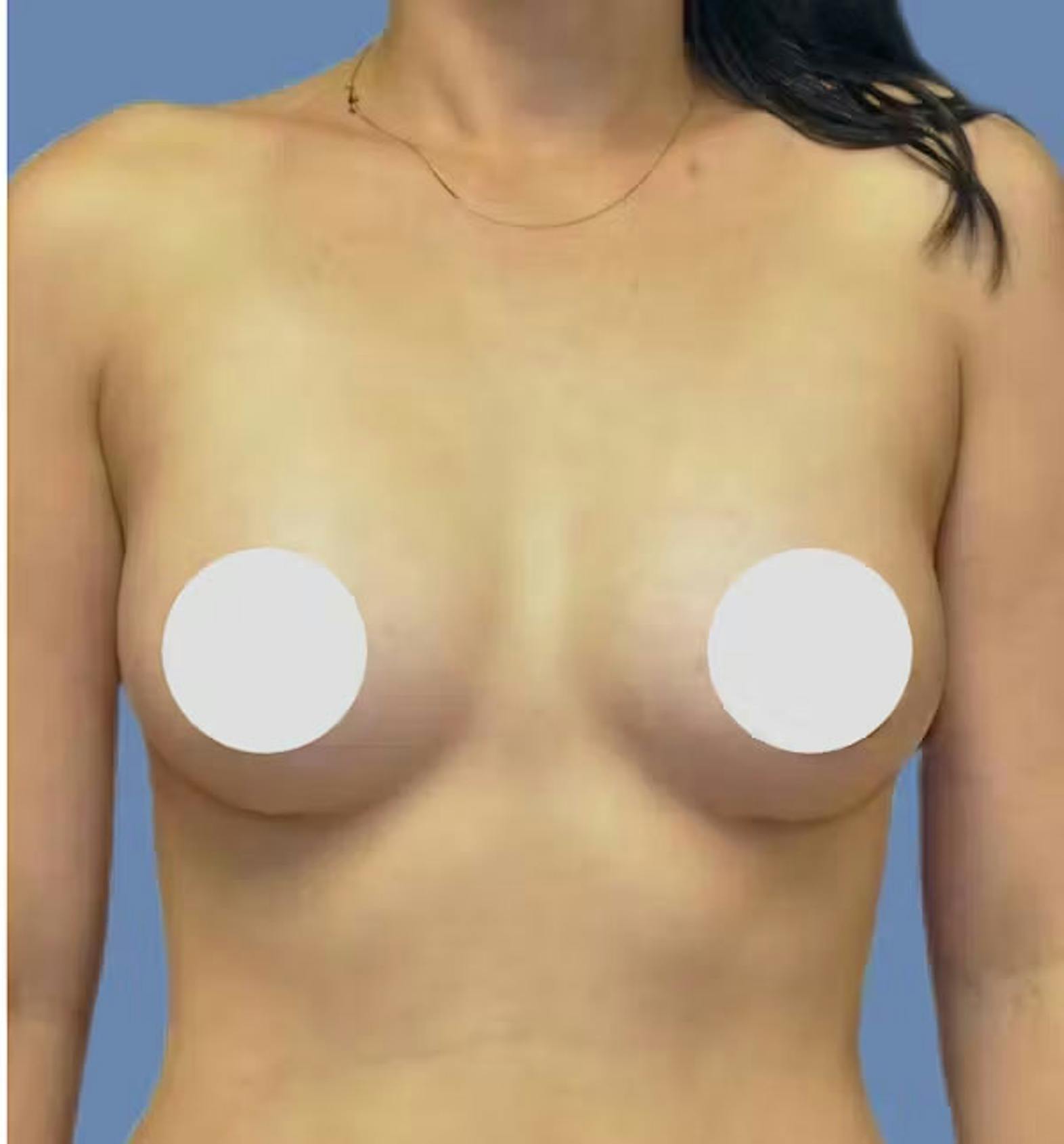 Breast augmentation patient after media