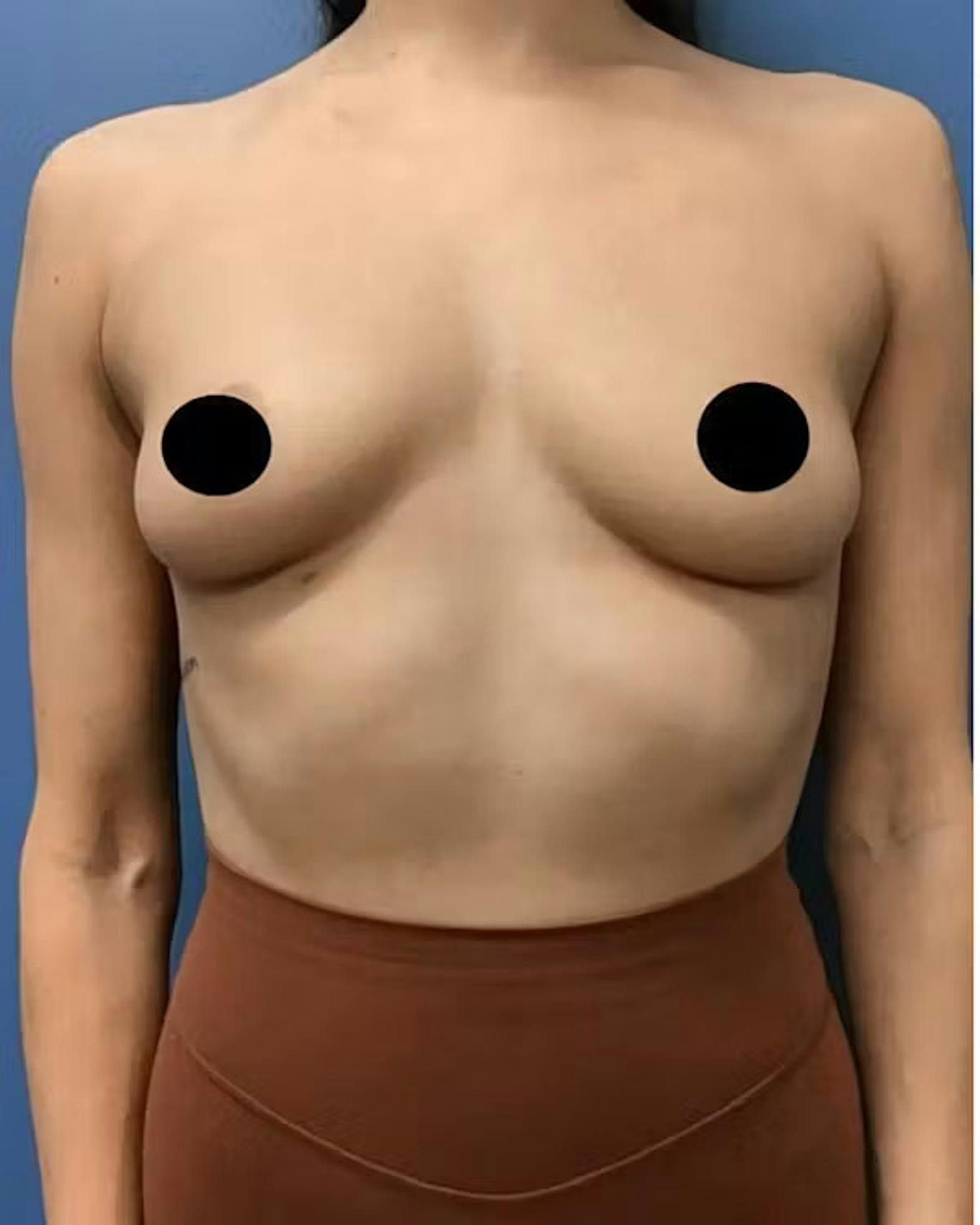 Breast augmentation patient before media