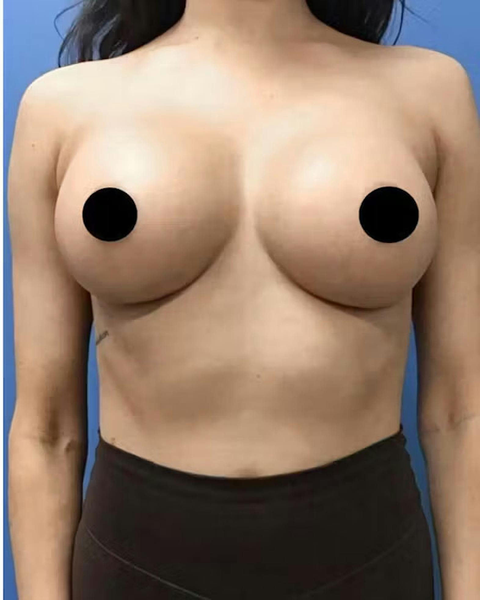 Breast augmentation patient after media