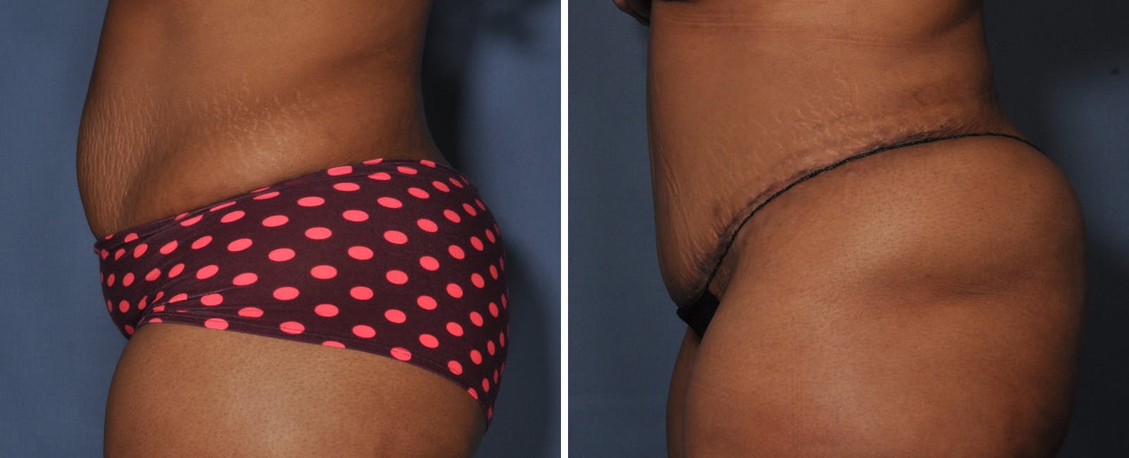 Abdominoplasty Before & After Gallery - Patient 203186 - Image 2