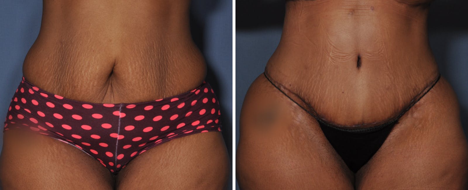 Abdominoplasty Before & After Gallery - Patient 203186 - Image 1