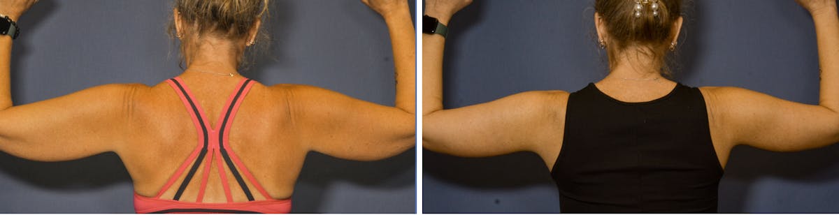 Brachioplasty Before & After Gallery - Patient 378997 - Image 2