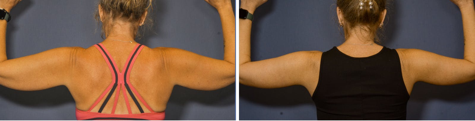 Brachioplasty Before & After Gallery - Patient 378997 - Image 2