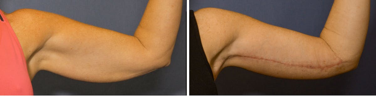 Brachioplasty Before & After Gallery - Patient 378997 - Image 1