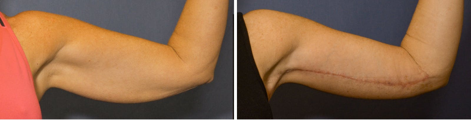 Brachioplasty Before & After Gallery - Patient 378997 - Image 1