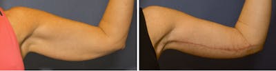 Brachioplasty Before & After Gallery - Patient 378997 - Image 1