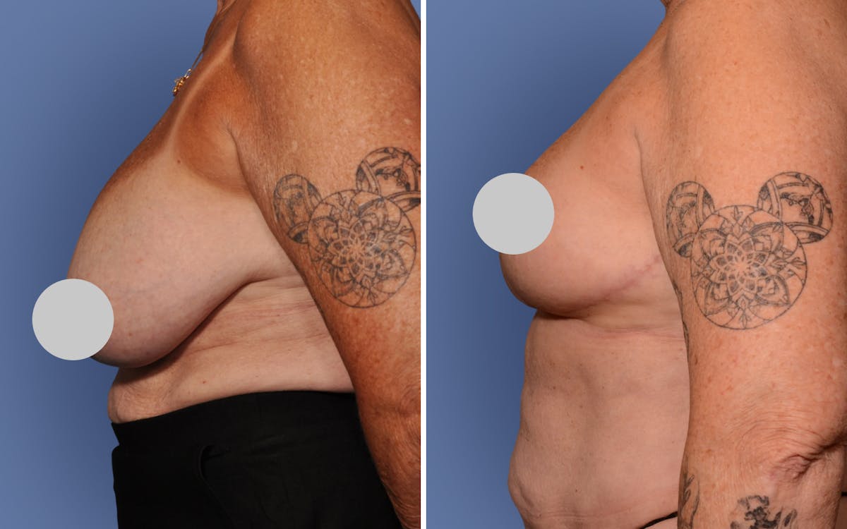 Breast Reduction Before & After Gallery - Patient 186883 - Image 2