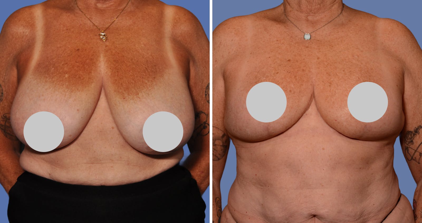 Breast Reduction Before & After Gallery - Patient 186883 - Image 1