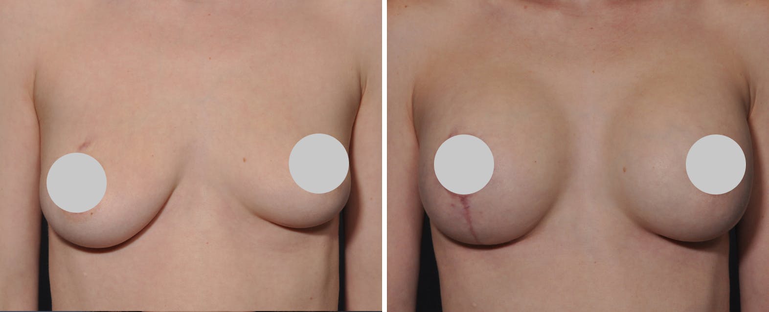 Breast augmentation patient before and aftermedia