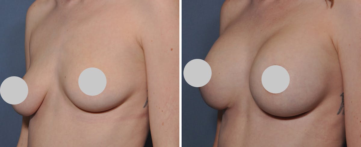 Breast Augmentation Before & After Gallery - Patient 274435 - Image 2