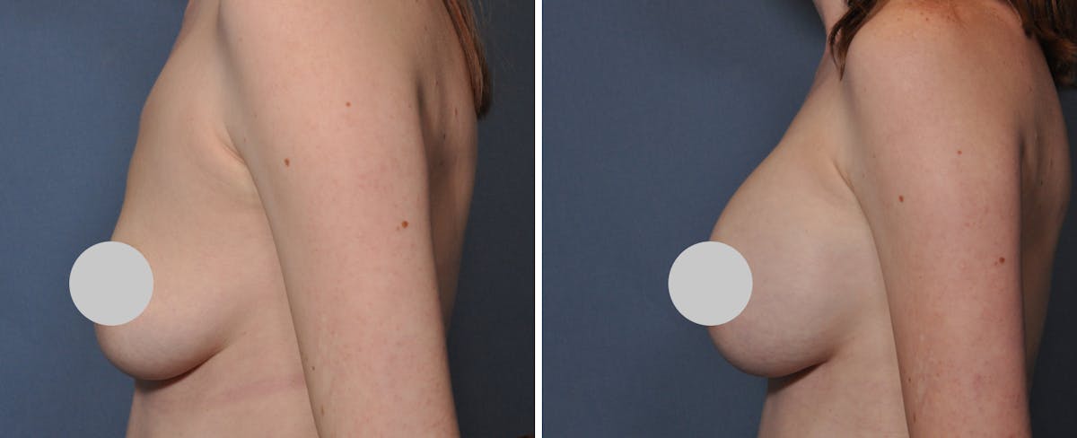 Breast Augmentation Before & After Gallery - Patient 274435 - Image 3