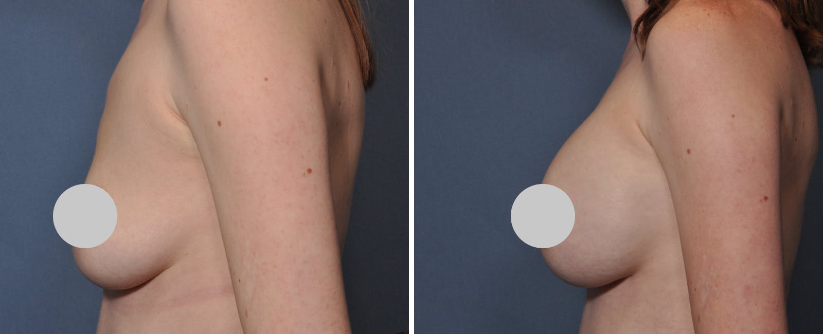 Breast Augmentation Before & After Gallery - Patient 274435 - Image 3