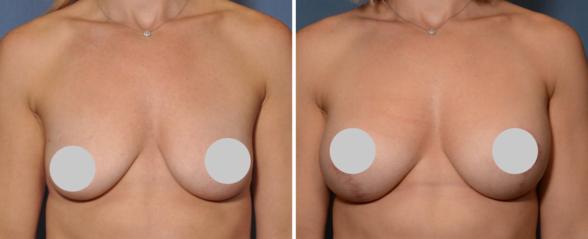Breast Augmentation & Lift Before & After Gallery - Patient 181959 - Image 1