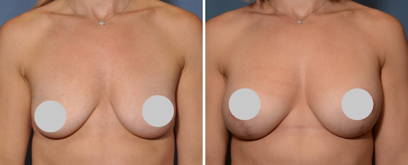 Breast Augmentation & Lift Before & After Gallery - Patient 181959 - Image 1