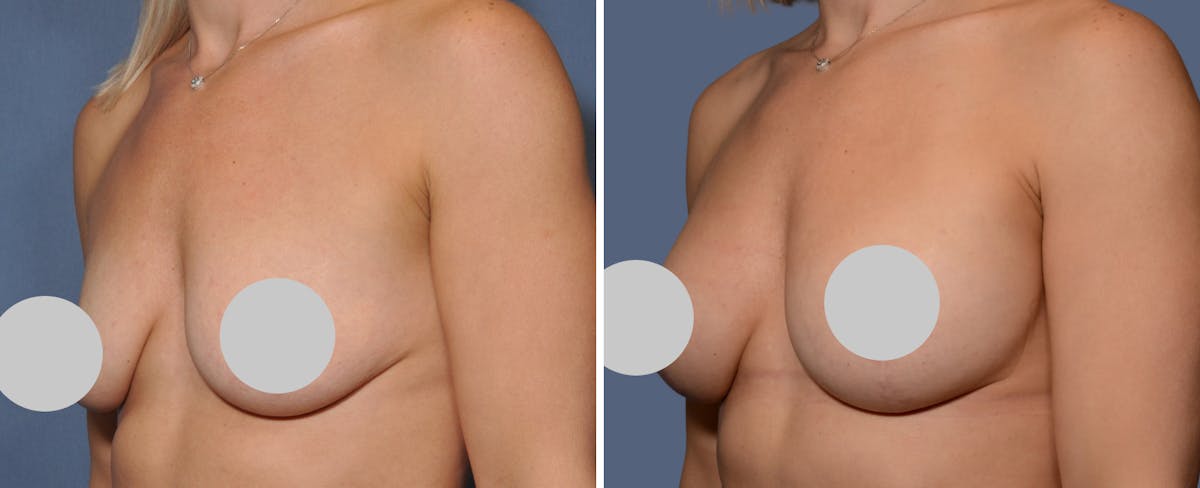 Breast Augmentation & Lift Before & After Gallery - Patient 181959 - Image 2