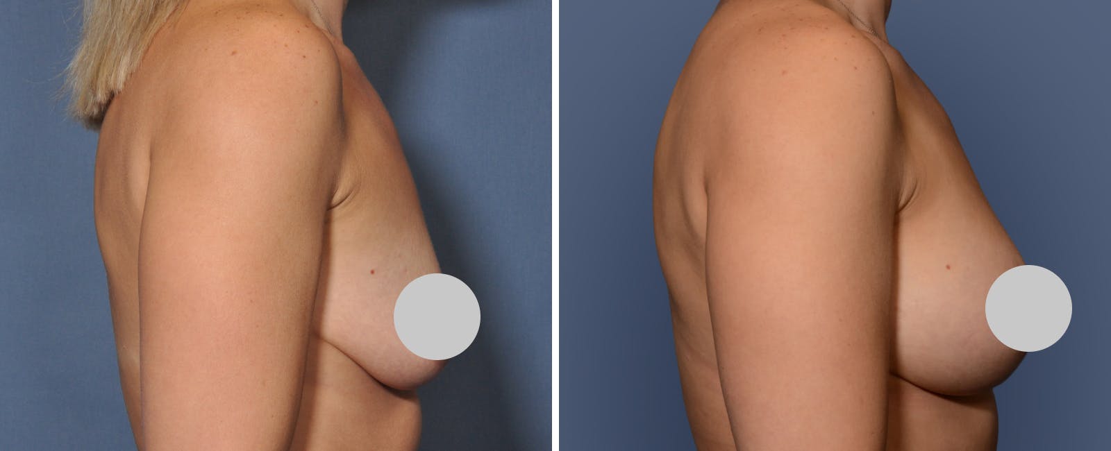 Breast Augmentation & Lift Before & After Gallery - Patient 181959 - Image 3
