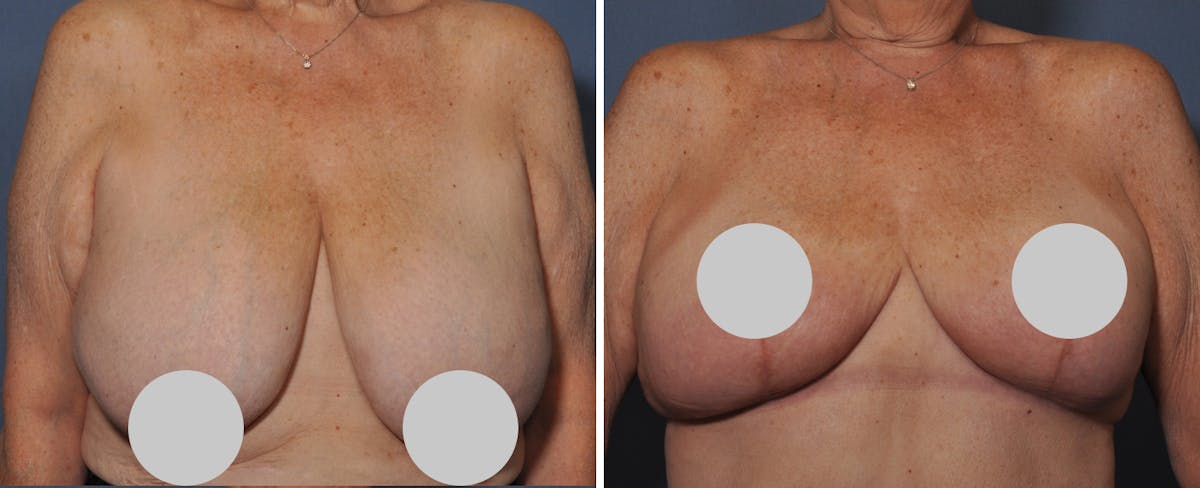 Breast Reduction Before & After Gallery - Patient 414433 - Image 1