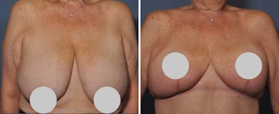 Breast Reduction Before & After Gallery - Patient 414433 - Image 1