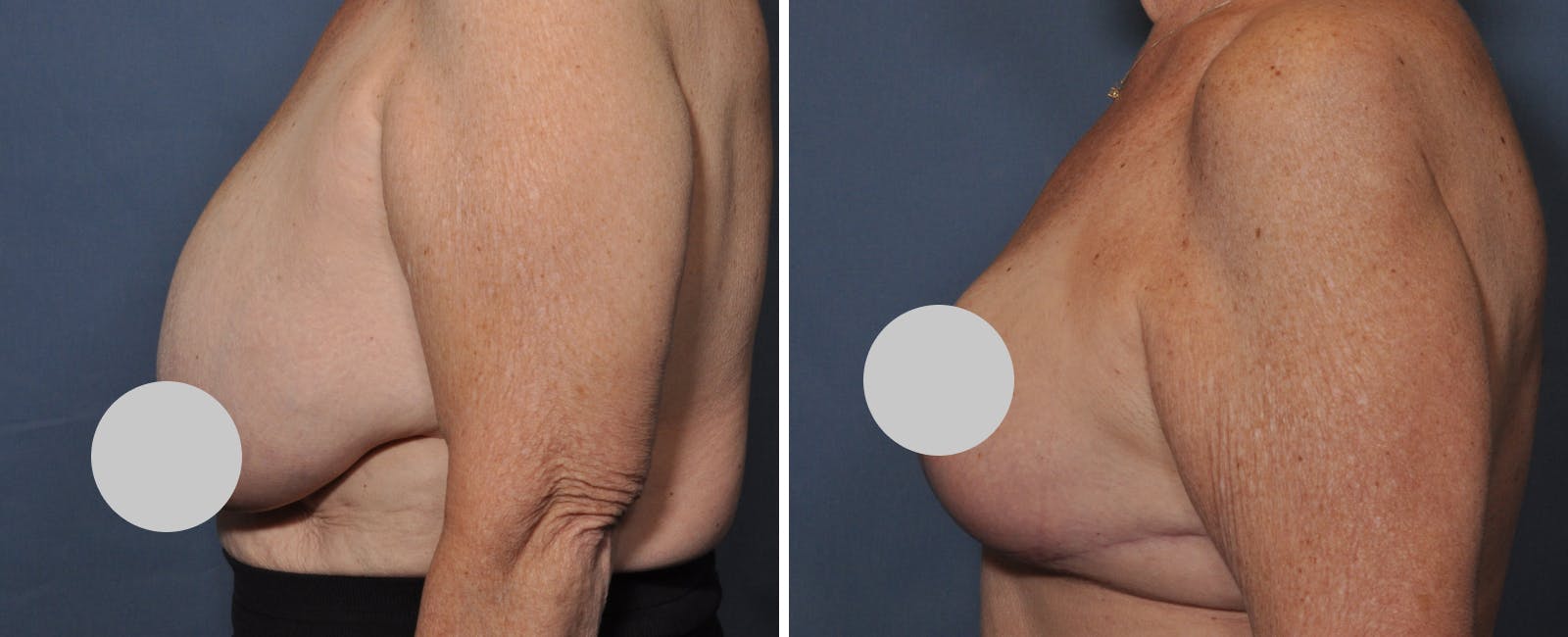 Breast Reduction Before & After Gallery - Patient 414433 - Image 3